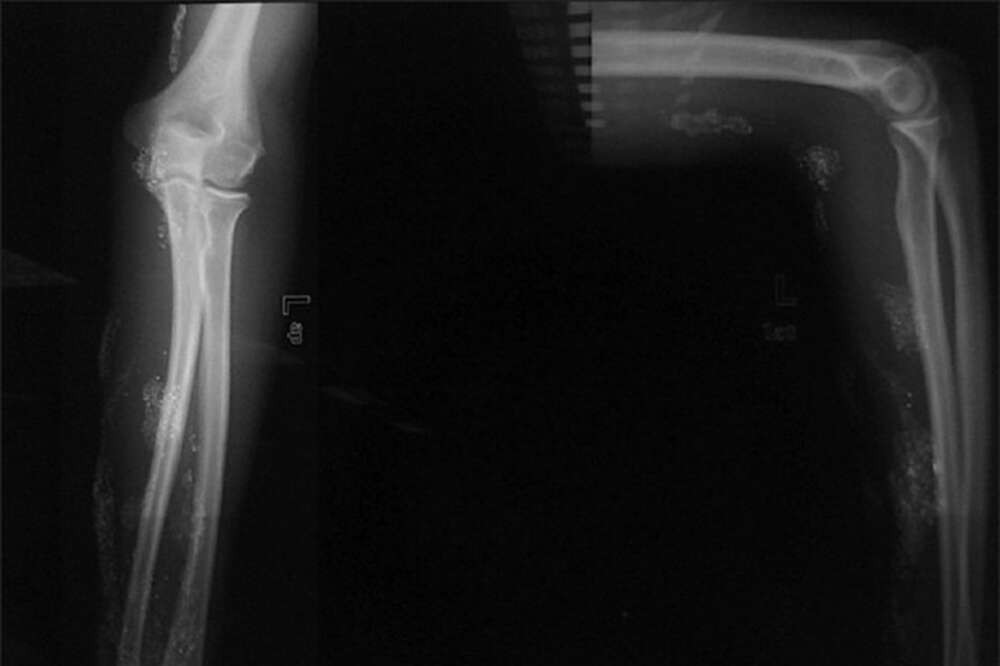 The mercury can be seen in his X-Rays