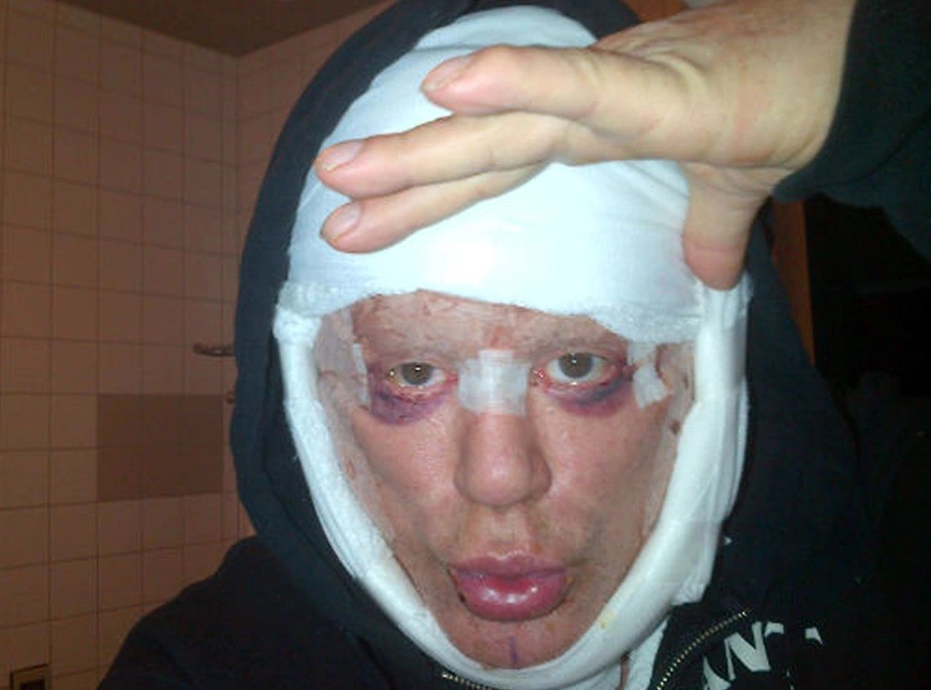 Mickey Rourke's Post Plastic Surgery Face