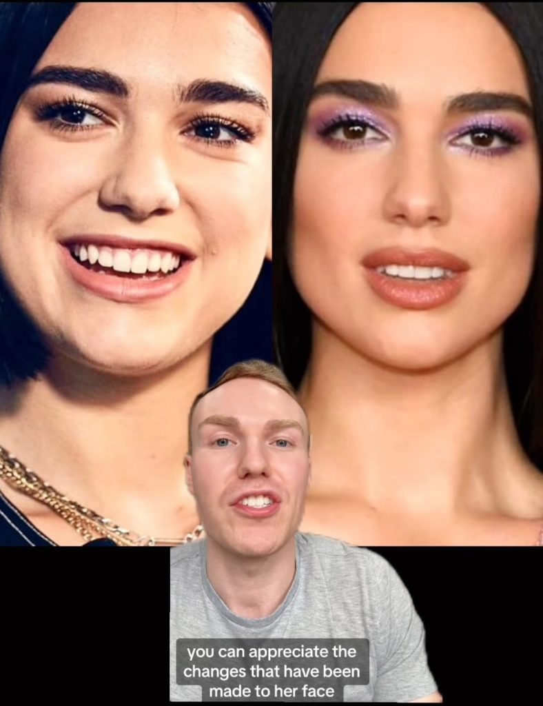 Before and After Pictures of Dua Lipa Since the Alleged Plastic ...