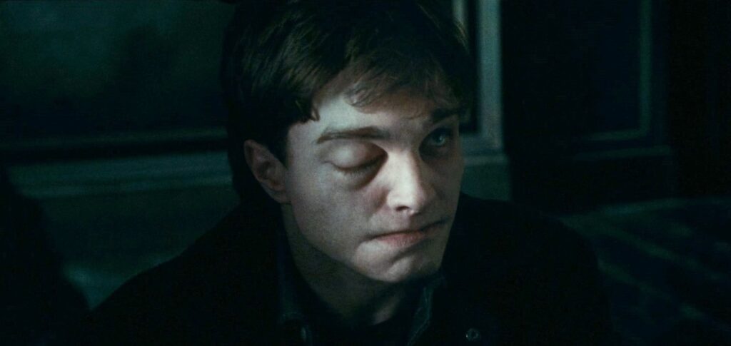 Harry with his messed-up face appears in Malfoy Manor. 